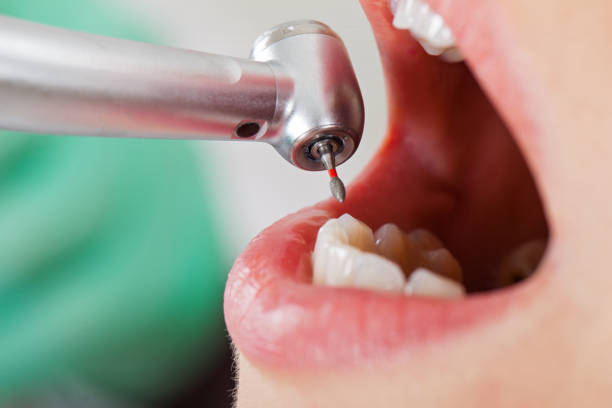 Best Knocked-Out Tooth (Avulsed Tooth) Treatment in Bristol, VA